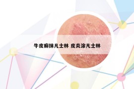 牛皮癬抹凡士林 皮炎涂凡士林