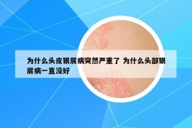 為什么頭皮銀屑病突然嚴(yán)重了 為什么頭部銀屑病一直沒好