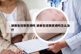 頑癬包括銀屑病嗎 頑癬包括銀屑病嗎怎么治療