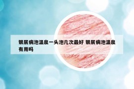 銀屑病泡溫泉一頭泡幾次最好 銀屑病泡溫泉有用嗎