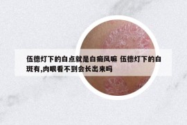 伍德燈下的白點(diǎn)就是白癜風(fēng)嘛 伍德燈下的白斑有,肉眼看不到會(huì)長(zhǎng)出來(lái)嗎