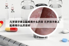 幾歲孩子身上起癬用什么藥膏 幾歲孩子身上起癬用什么藥膏好