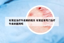 石家莊治療牛皮癬的地方 石家莊有專門治療牛皮的醫(yī)院嗎