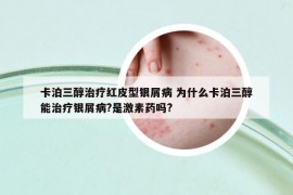卡泊三醇治療紅皮型銀屑病 為什么卡泊三醇能治療銀屑病?是激素藥嗎?