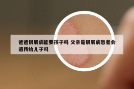 爸爸銀屑病能要孩子嗎 父親是銀屑病患者會(huì)遺傳給兒子嗎