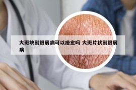 大斑塊副銀屑病可以痊愈嗎 大斑片狀副銀屑病