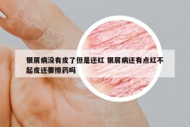 銀屑病沒(méi)有皮了但是還紅 銀屑病還有點(diǎn)紅不起皮還要擦藥嗎