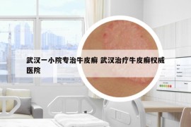 武漢一小院專治牛皮癬 武漢治療牛皮癬權(quán)威醫(yī)院