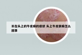 長(zhǎng)在頭上的牛皮癬的癥狀 頭上牛皮膚癬怎么回事