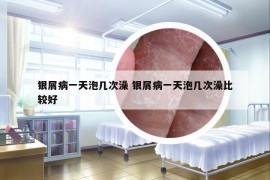 銀屑病一天泡幾次澡 銀屑病一天泡幾次澡比較好