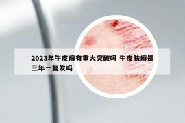 2023年牛皮癬有重大突破嗎 牛皮膚癬是三年一復(fù)發(fā)嗎