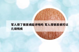 軍人得了銀屑病能評殘嗎 軍人得銀屑病可以幾級殘疾
