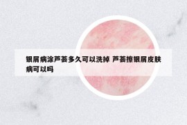 銀屑病涂蘆薈多久可以洗掉 蘆薈擦銀屑皮膚病可以嗎
