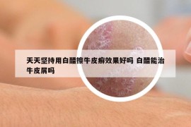 天天堅持用白醋擦牛皮癬效果好嗎 白醋能治牛皮屑嗎