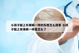 小孩子腿上長(zhǎng)跟癬一樣的東西怎么回事 小孩子腿上有像癬一樣是怎么了