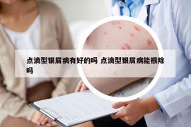 點(diǎn)滴型銀屑病有好的嗎 點(diǎn)滴型銀屑病能根除嗎