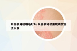 銀屑病用硫磺皂好嗎 銀屑病可以用硫磺軟膏洗頭發(fā)