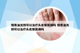 煤焦油洗劑可以治療頭皮銀屑病嗎 煤焦油洗劑可以治療頭皮銀屑病嗎