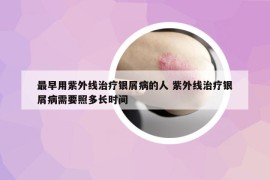 最早用紫外線治療銀屑病的人 紫外線治療銀屑病需要照多長時間