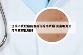 濟南市皮膚病防治院治療牛皮癬 濟南哪兒治療牛皮癬比較好