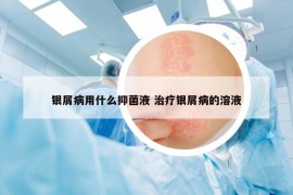 銀屑病用什么抑菌液 治療銀屑病的溶液
