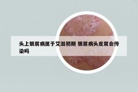 頭上銀屑病屬于艾滋初期 銀屑病頭皮屑會傳染嗎