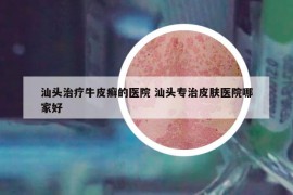 汕頭治療牛皮癬的醫(yī)院 汕頭專治皮膚醫(yī)院哪家好