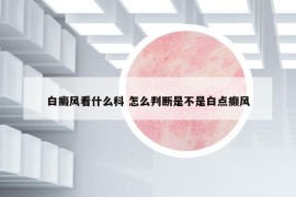 白癜風(fēng)看什么科 怎么判斷是不是白點(diǎn)癲風(fēng)