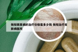 衡陽銀屑病的治療價(jià)格是多少錢 衡陽治療皮膚病醫(yī)院