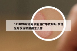 311UVB窄譜光波能治療牛皮癬嗎 窄譜光療儀治銀屑病怎么樣