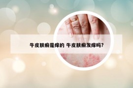 牛皮膚癬是癢的 牛皮膚癬發(fā)癢嗎?