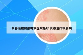 長春治銀屑病哪家醫(yī)院最好 長春治療銀屑病