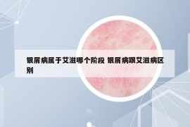 銀屑病屬于艾滋哪個階段 銀屑病跟艾滋病區(qū)別