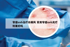 窄譜uvb治療白癜風(fēng) 家用窄譜uvb光療效果好嗎
