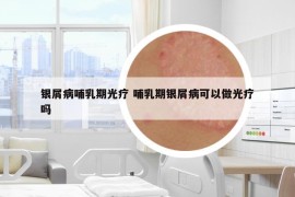 銀屑病哺乳期光療 哺乳期銀屑病可以做光療嗎