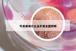 牛皮癬用什么治不用去醫(yī)院呢
