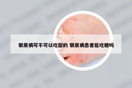 銀屑病可不可以吃甜的 銀屑病患者能吃糖嗎