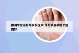 徐州專業(yè)治療牛皮癬醫(yī)院 徐州銀屑病哪個醫(yī)院好
