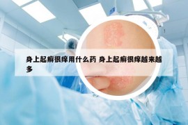 身上起癬很癢用什么藥 身上起癬很癢越來(lái)越多