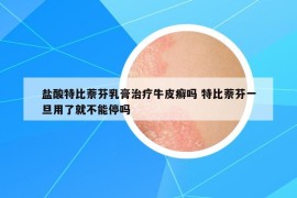 鹽酸特比萘芬乳膏治療牛皮癬嗎 特比萘芬一旦用了就不能停嗎