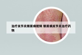 治療關(guān)節(jié)炎銀屑病視頻 銀屑病關(guān)節(jié)炎治療藥物