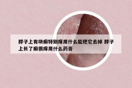 脖子上有塊癬特別癢用什么能把它去掉 脖子上長(zhǎng)了癬很癢用什么藥膏