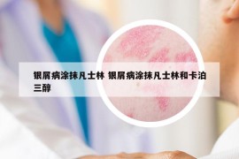 銀屑病涂抹凡士林 銀屑病涂抹凡士林和卡泊三醇