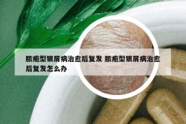 膿皰型銀屑病治愈后復(fù)發(fā) 膿皰型銀屑病治愈后復(fù)發(fā)怎么辦