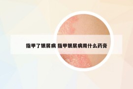 指甲了銀屑病 指甲銀屑病用什么藥膏