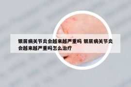 銀屑病關(guān)節(jié)炎會越來越嚴(yán)重嗎 銀屑病關(guān)節(jié)炎會越來越嚴(yán)重嗎怎么治療