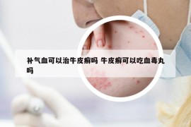 補氣血可以治牛皮癬嗎 牛皮癬可以吃血毒丸嗎