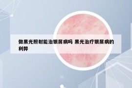 做黑光照射能治銀屑病嗎 黑光治療銀屑病的利弊