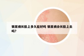 銀屑病長臉上多久能好嗎 銀屑病會長臉上去嗎?