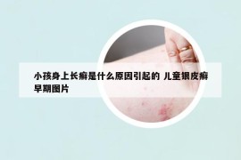 小孩身上長(zhǎng)癬是什么原因引起的 兒童銀皮癬早期圖片
